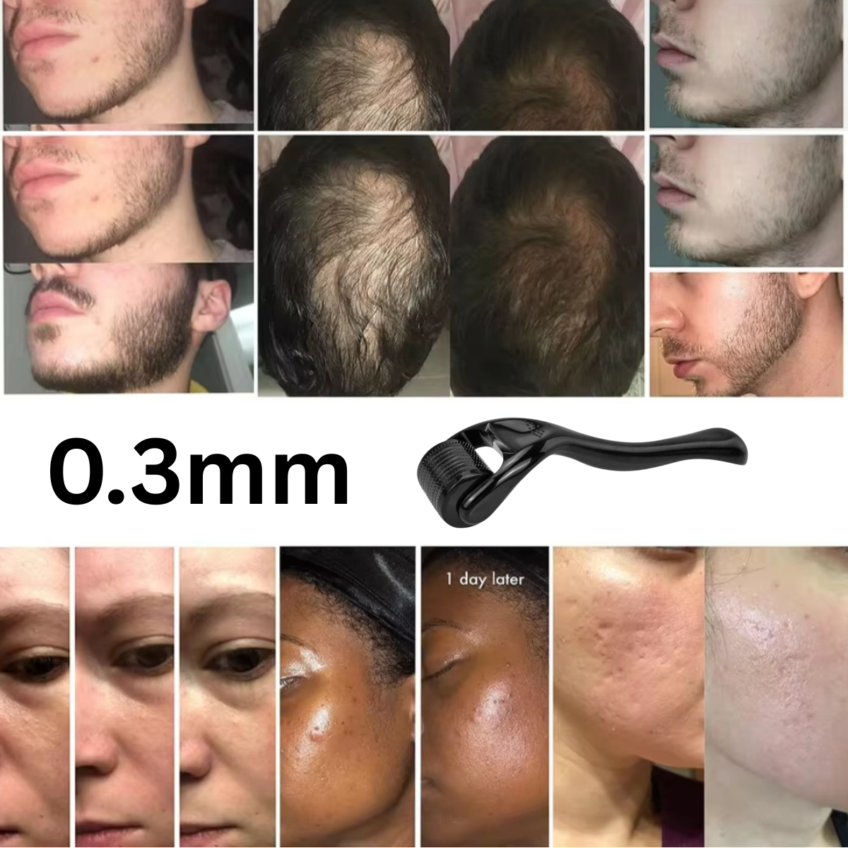 Derma Roller with 540 Micro Needles – For Skin, Hair & Beard Care